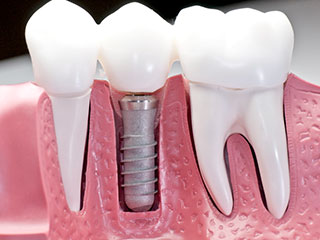 lnd_dental_implants